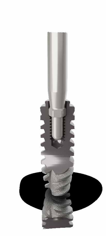 Implantes Dentários